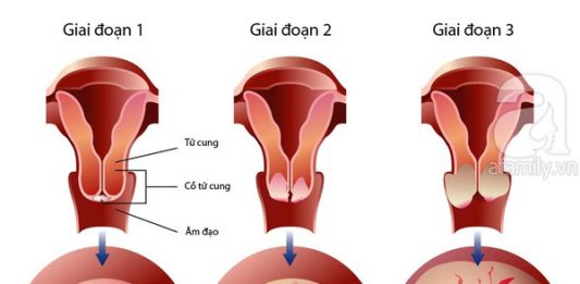 Dấu hiệu sớm nhận biết ung thư cổ tử cung