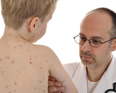 “Bệnh thủy đậu” mách mẹ cách chăm sóc và phòng ngừa cho trẻ