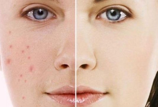 Cách trị mụn bị thâm và sưng đỏ